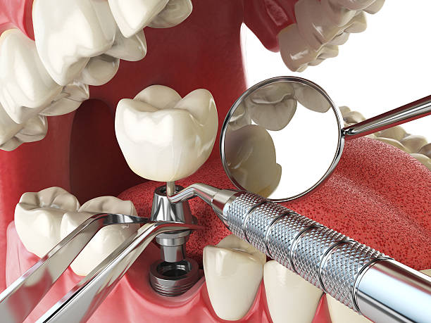 Best Emergency Tooth Extraction in Vian, OK